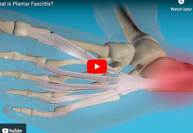 Plantar Fasciitis Video